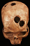 Trepanación cráneana